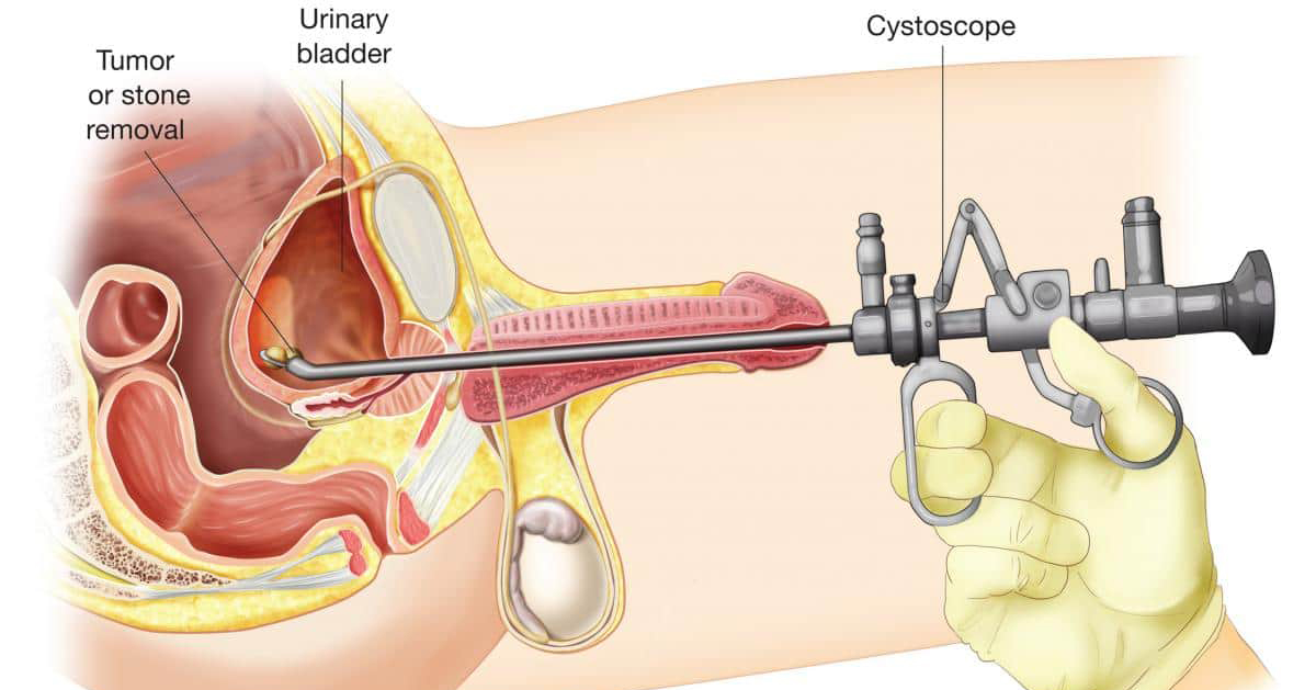Endoscopic Stone Surgery